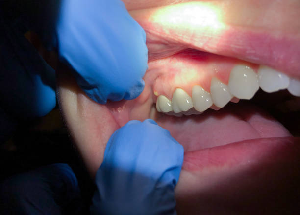 Best Emergency Dental Care for Abscessed Tooth in Beaufort, SC